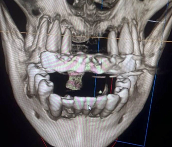 CBCT Scan frontal view