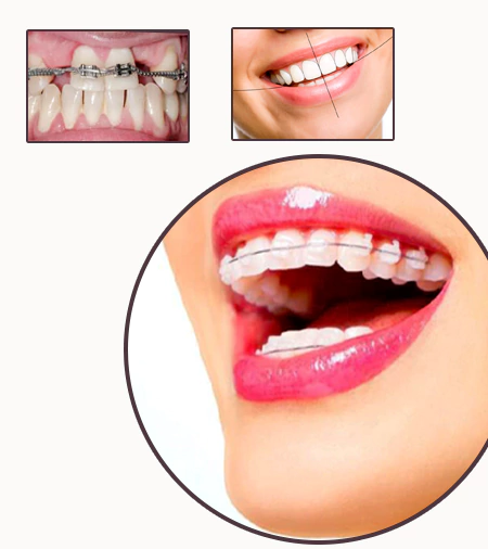 Restoring orthodontic treatment