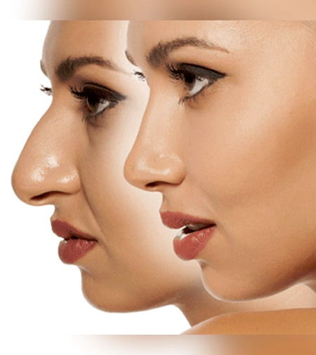 before & after nose surgery