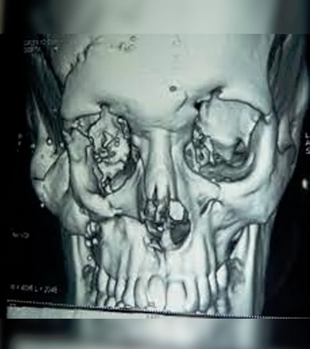 jaw bone trauma surgery