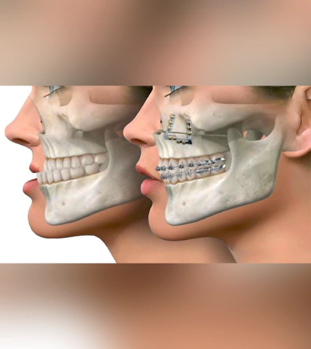 upper jaw maxillary osteotomy