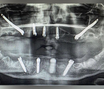 Radiograph after Zygoma Implant placement