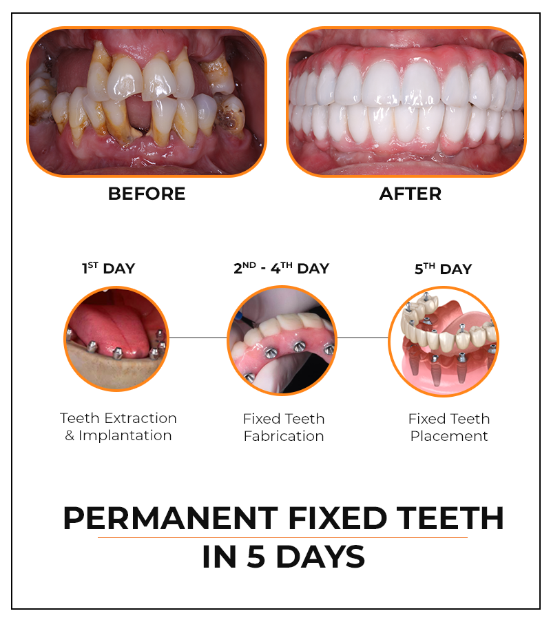 Permanent fixed teeth in 5days in Hyderabad