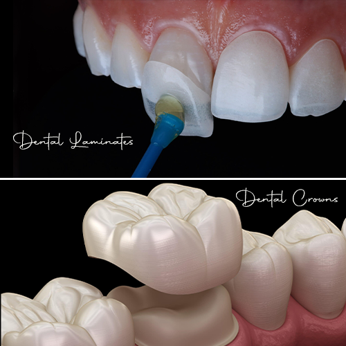 Dental laminates vs dental crowns