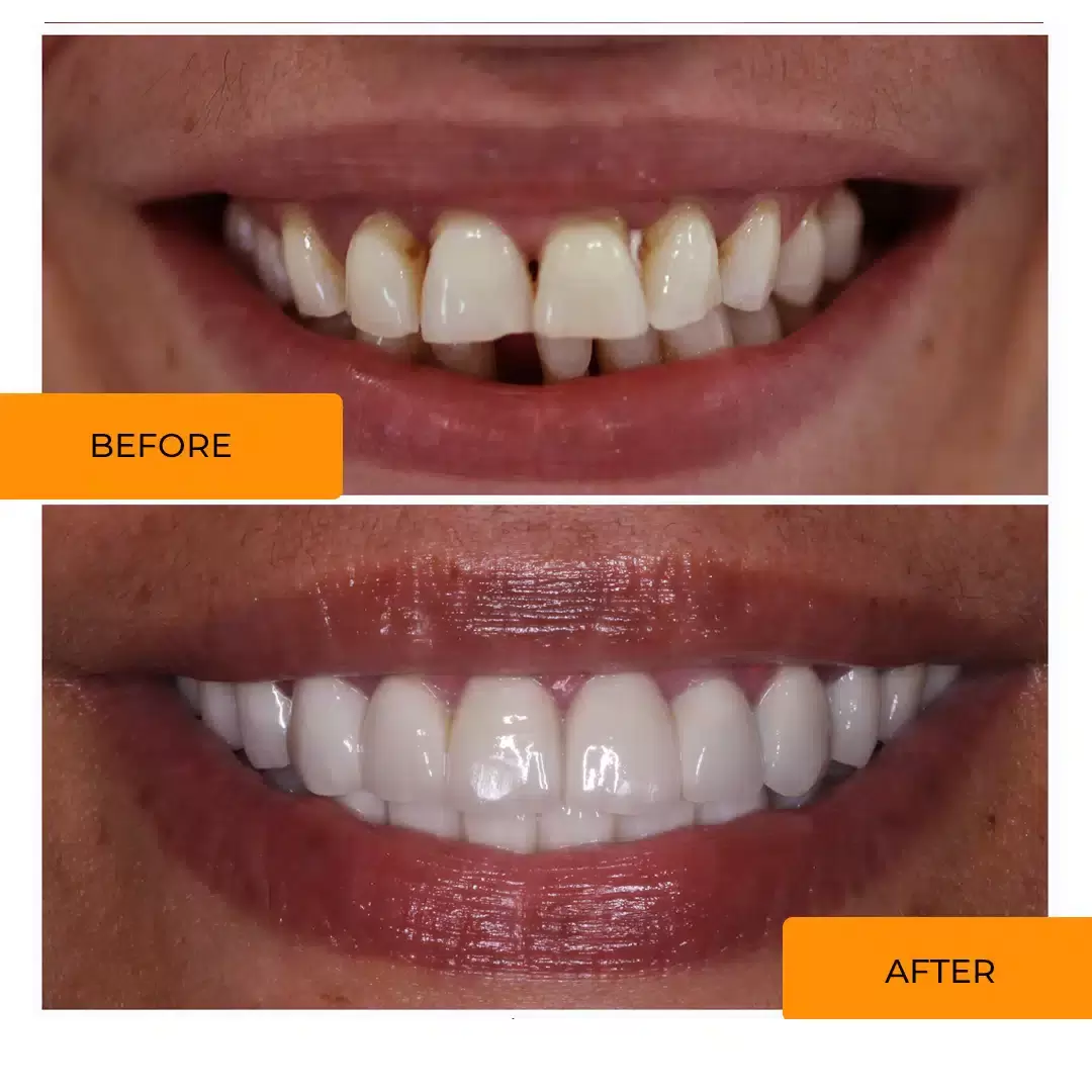 types of dental veneers