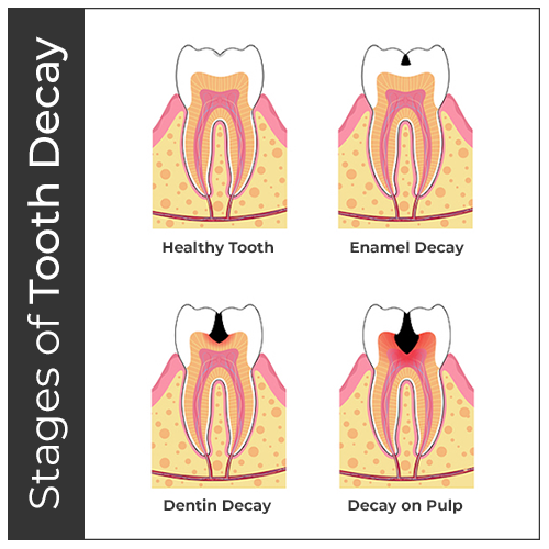 Tooth Decay Progress & Treatment