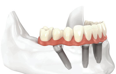 all-on-4-dental-implant-technique