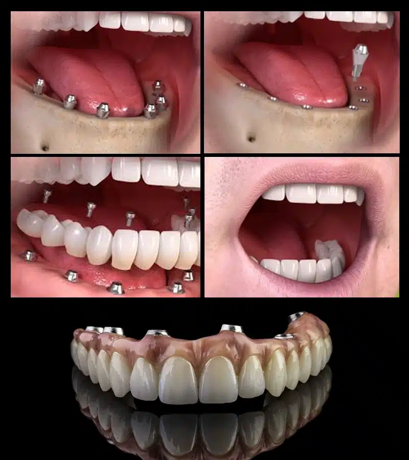 Full Mouth Dental Implants