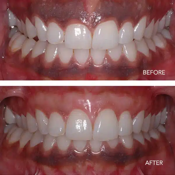 gum depigmentation before & after