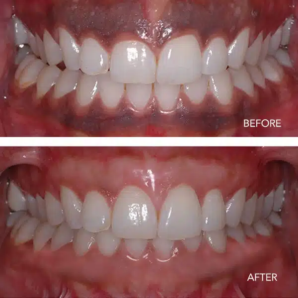 gum depigmentation before & after copy 2