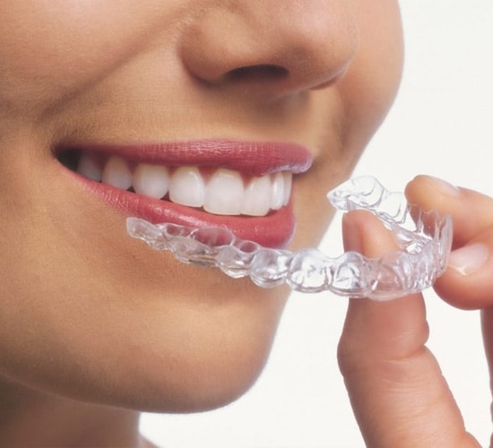 Clear Aligners Braces