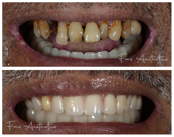 Dental Implants Treatment 1