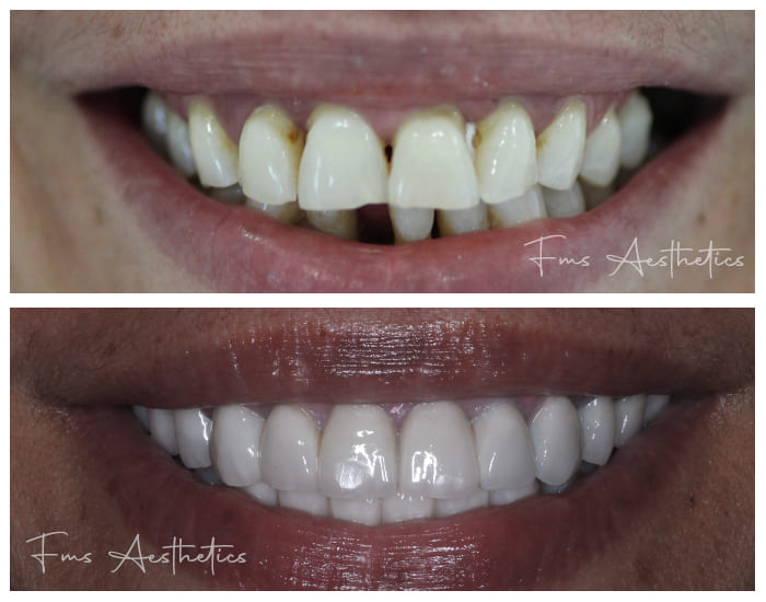 Dental Implants Treatment3
