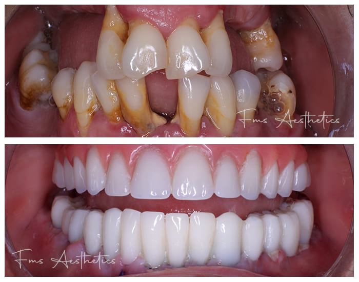 Dental Implants Treatment4