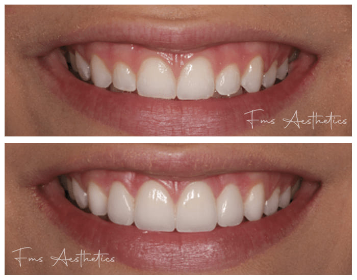 Smile Correction treatment in hyderabad