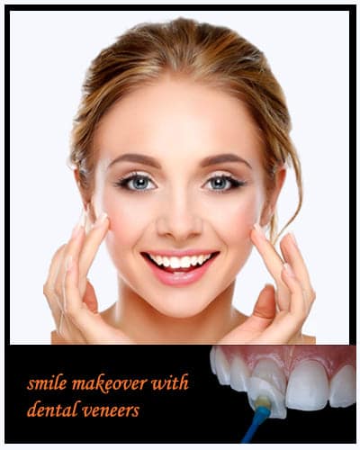 smile make over with dental veeners