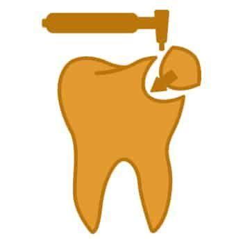 laser-composite-fillings