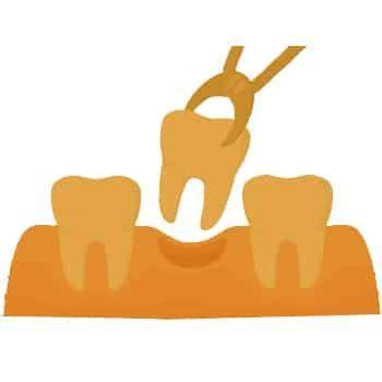 wisdom-tooth-removal