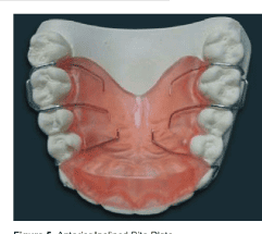 ANTERIOR PROCLINATION