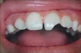 DENTAL TRAUMA IN CHILDREN