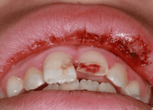 MANAGEMENT OF DENTAL TRAUMA IN CHILDREN