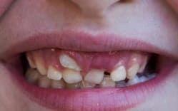 MILK TEETH EXTRACTIONS FMS