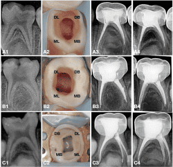 PULPECTOMY ROOTCANAL TREATMENT FOR MILK TEETH