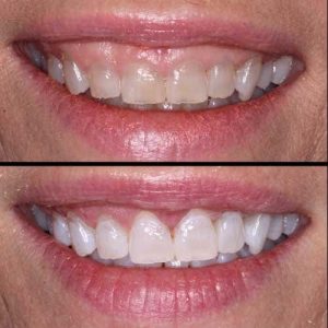 Laser Gum Shaping in Hyderabad India
