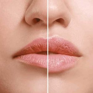 Lip Enhancement treatment in Hyderabad India