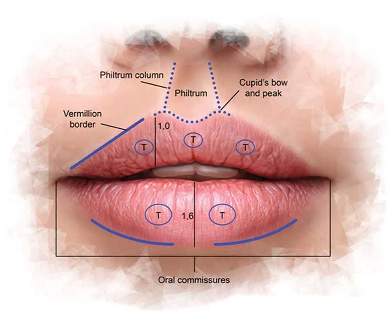 Lip Lengthening Treatment