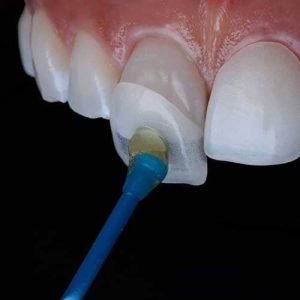 Porcelain veneer treatment in Hyderabad India