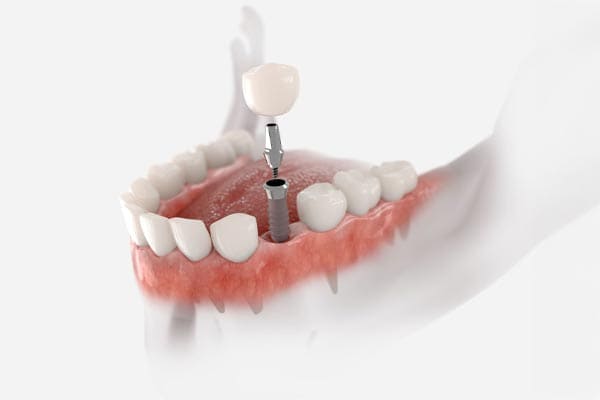 Why Dental Implants