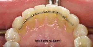 Splinting | FMS DENTAL HOSPITAL