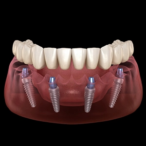 All-on-6 Dental Implants