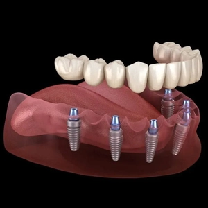 All-on-4 Dental Implants