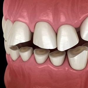 Bruxism (Teeth Grinding)