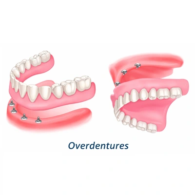 Implant-Supported Dentures