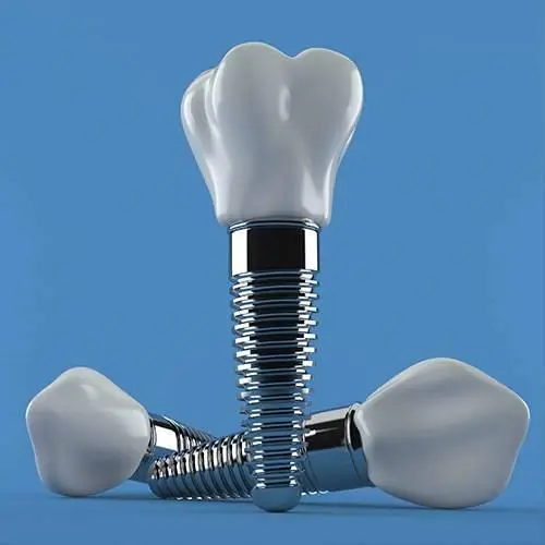 Single Tooth Dental Implant