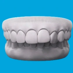 Overbite