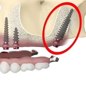 Pterygoid Implants