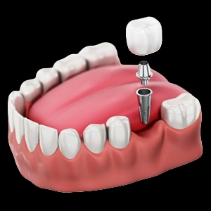 Single Tooth Implants