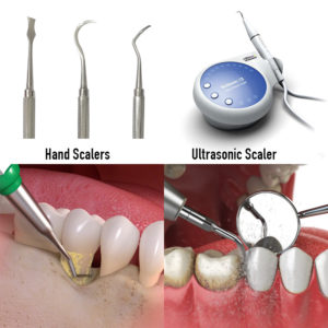 Root Planing Instruments Scaling & Root Planing Treatment in Hyderabad India, FMS Dental