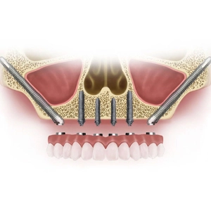 Zygomatic Implants