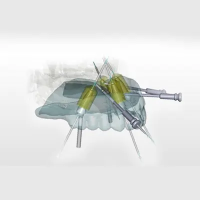 Computer-Guided Implant Surgery