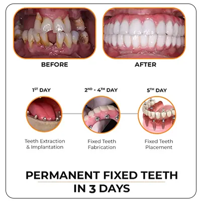 Immediate Loading Implants