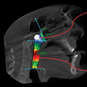 Airway Volumetry