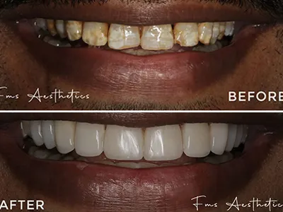 Composite Bonding