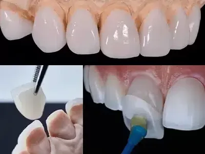  Dental Veneers Hyderabad