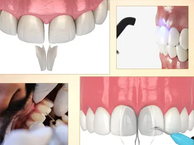  Dental Bonding