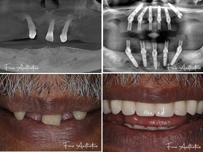 Full Mouth Rehabilitation with Implant Prosthetics